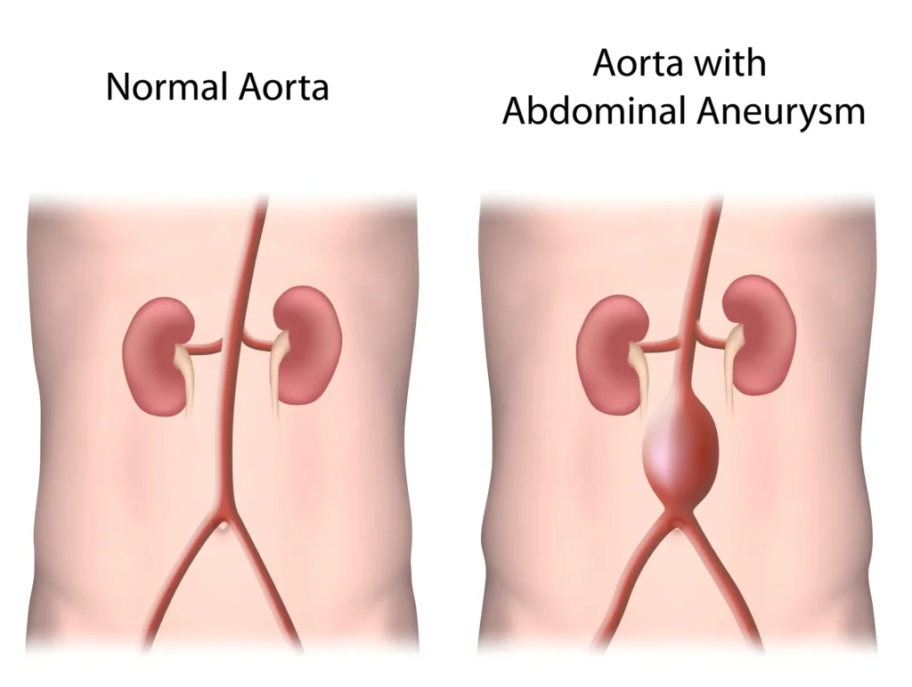 Aorta Aneurysm graphic