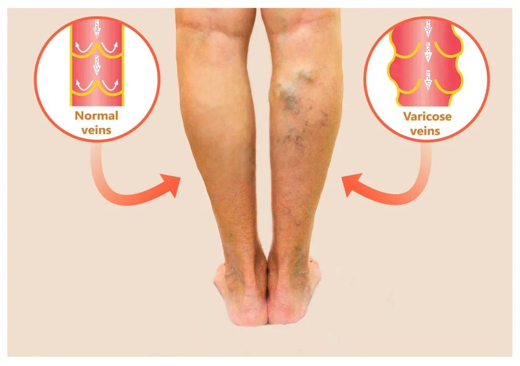 legs with varicose viens